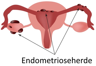 Zeichnung der Gebärmutter mit roten Flecken drauf (Endometrioseherde)